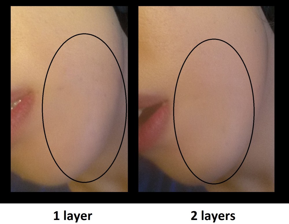 5-1-vs-2-layers-on-acne-scars